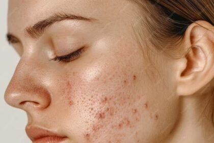 natural remedies for acne